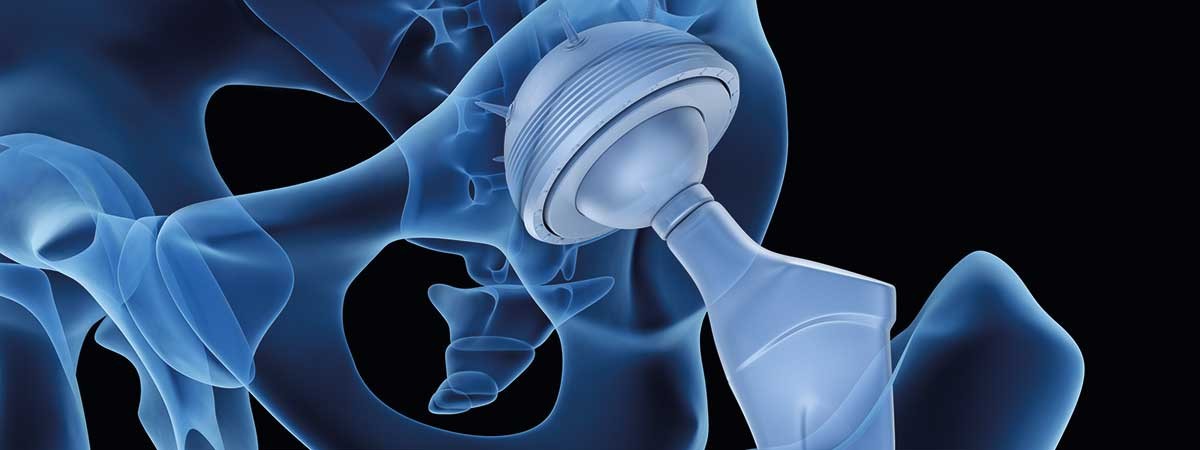 hipreplacement_shutterstock_512529526_300dpi_rgb
